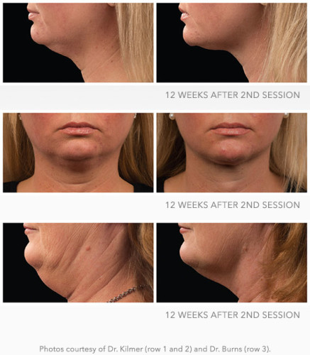CoolSculpting Cool Mini information provided by Dr. Scott Hernberg of Tomorrow's Wellness Center, NJ's premier med spa.